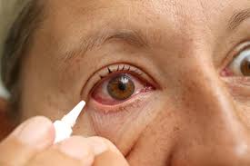 red eye treatment